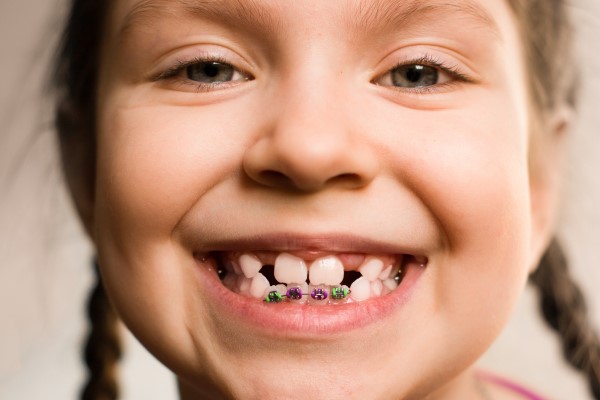 Choosing The Right Braces For Kids